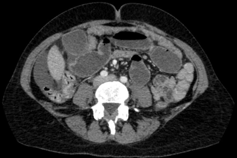 File:Closed loop small bowel obstruction (Radiopaedia 71211-81508 A 76).jpg