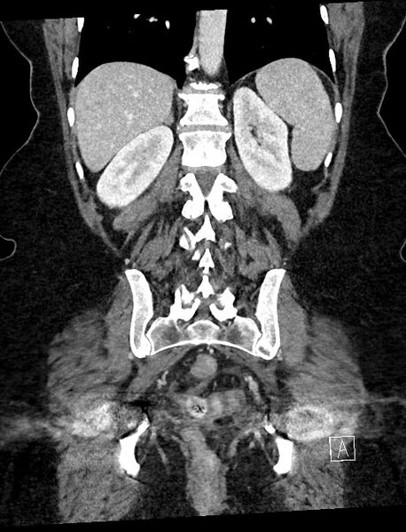 File:Closed loop small bowel obstruction - adhesions (Radiopaedia 59078-66369 B 90).jpg