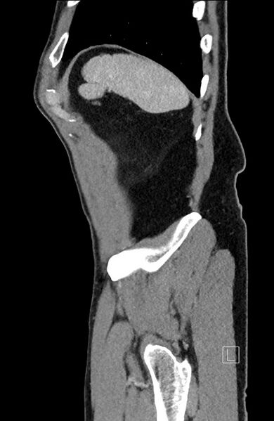 File:Closed loop small bowel obstruction - internal hernia (Radiopaedia 57806-64778 C 19).jpg