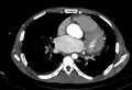 Coarctation of aorta with aortic valve stenosis (Radiopaedia 70463-80574 A 114).jpg