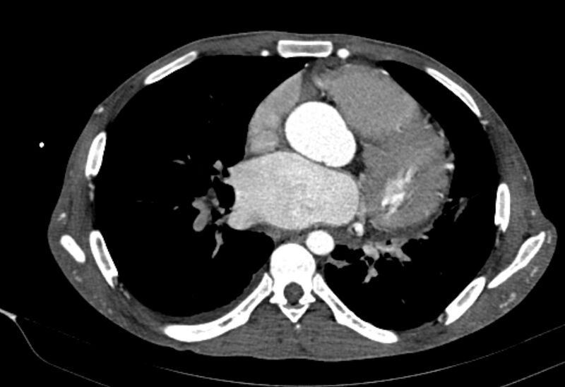 File:Coarctation of aorta with aortic valve stenosis (Radiopaedia 70463-80574 A 114).jpg