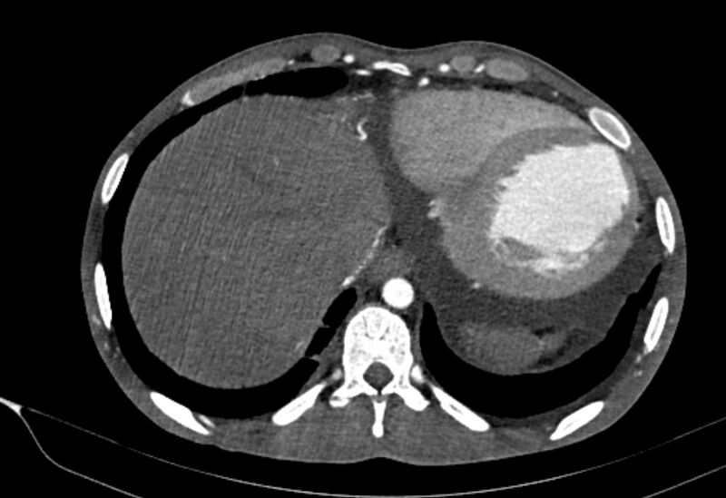 File:Coarctation of aorta with aortic valve stenosis (Radiopaedia 70463-80574 A 198).jpg