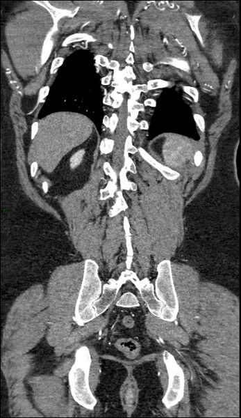 File:Coarctation of the aorta (Radiopaedia 74632-88521 B 209).jpg