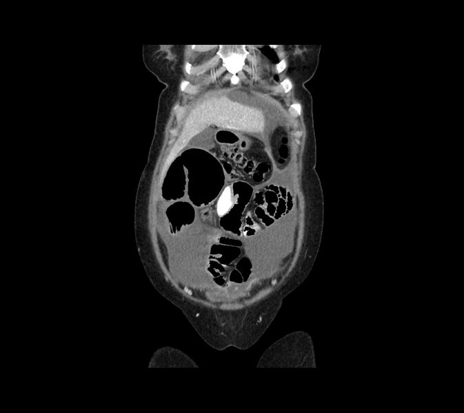 File:Cocoon abdomen with possible tubo-ovarian abscess (Radiopaedia 46235-50636 B 9).jpg