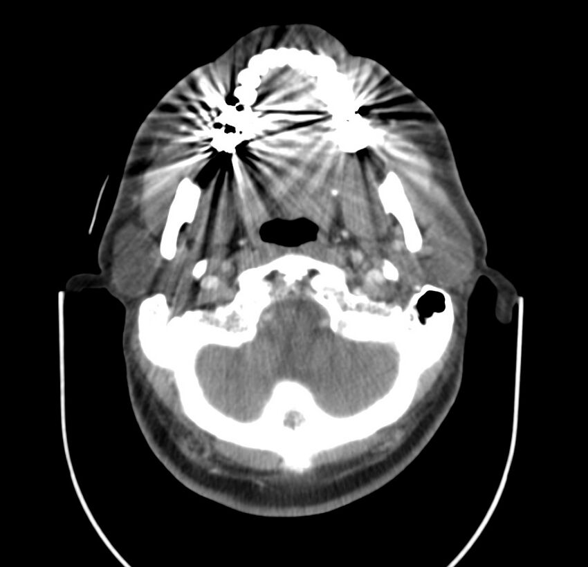 Colloid cyst of thyroid (Radiopaedia 22897-22923 Axial C+ delayed 19).jpg