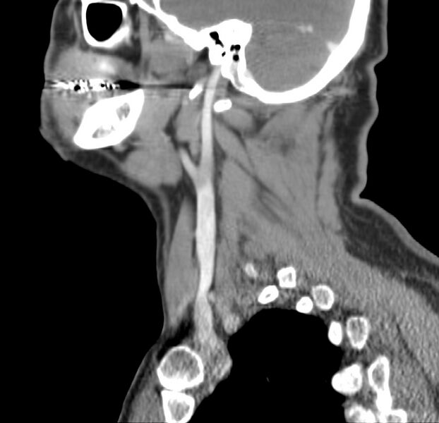 File:Colloid cyst of thyroid (Radiopaedia 22897-22923 Sagittal C+ delayed 19).jpg