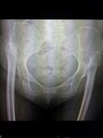 Congenital hip dislocation