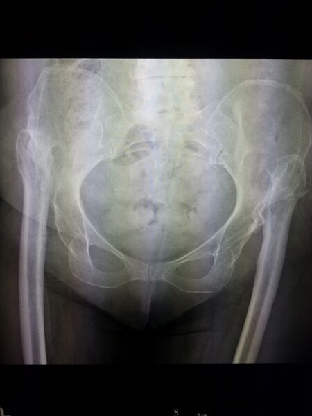 File:Congenital hip dislocation (Radiopaedia 24899).jpg