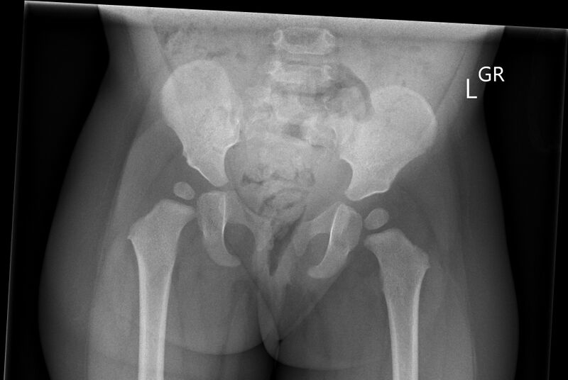 File:Developmental dysplasia of the hip (Radiopaedia 26763).jpg