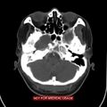 Nasopharyngeal carcinoma recurrence - skull base destruction (Radiopaedia 29107-29491 A 6).jpg