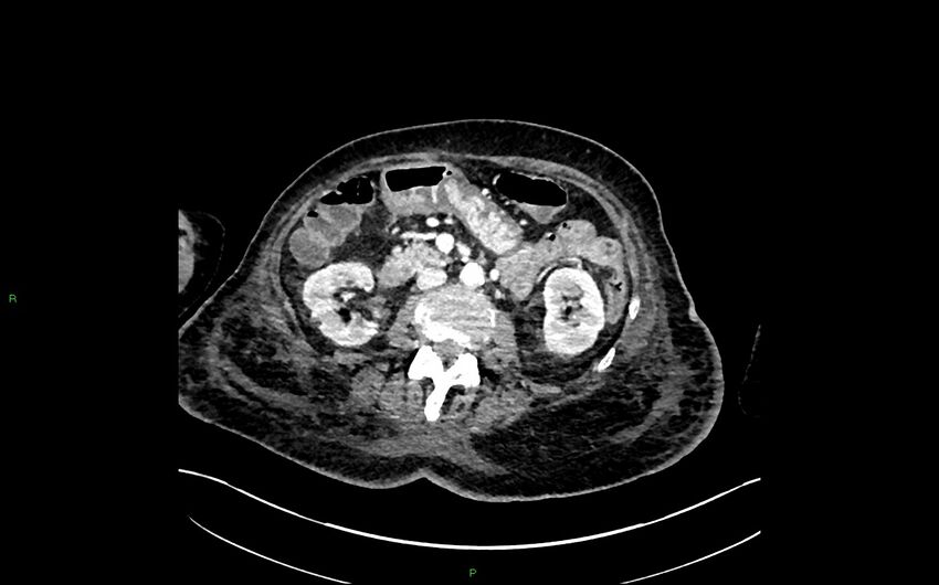 Neo-terminal ileal stricture (Crohn disease) (Radiopaedia 33790-34948 A 190).jpg