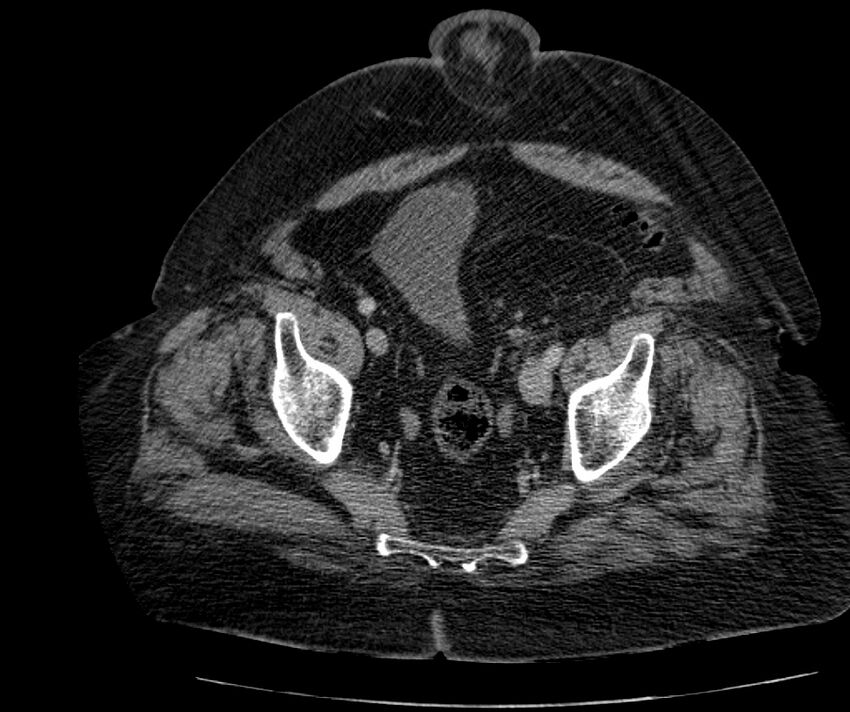 Nephroptosis with inguinal hernia containing perirenal fat (Radiopaedia 56632-63391 C 293).jpg