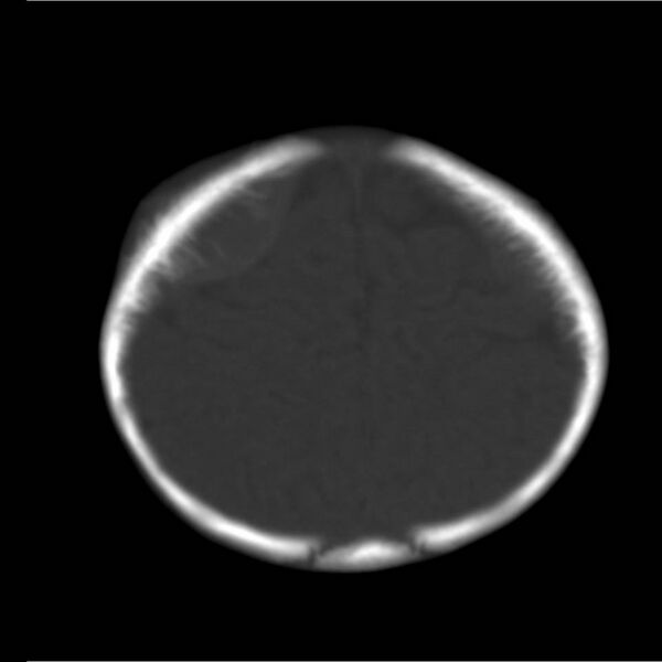 File:Neuroblastoma with skull metastases (Radiopaedia 30326-30958 Axial bone window 19).jpg