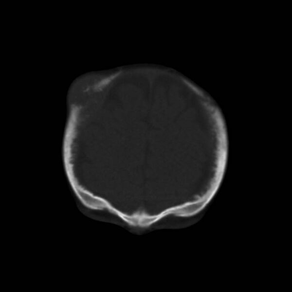 File:Neuroblastoma with skull metastases (Radiopaedia 30326-30958 Coronal bone window 10).jpg