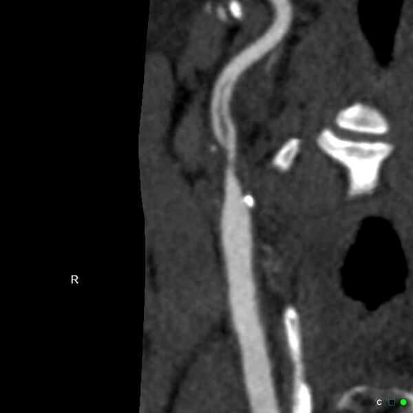 File:Non-occlusive intraluminal internal carotid artery thrombus (Radiopaedia 37751-39658 A 3).jpg