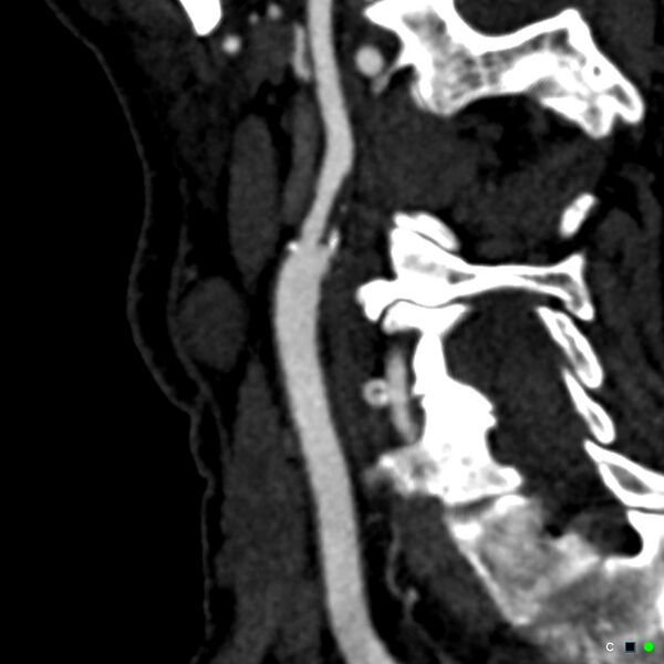 File:Non-occlusive intraluminal internal carotid artery thrombus (Radiopaedia 37751-39658 C 45).jpg