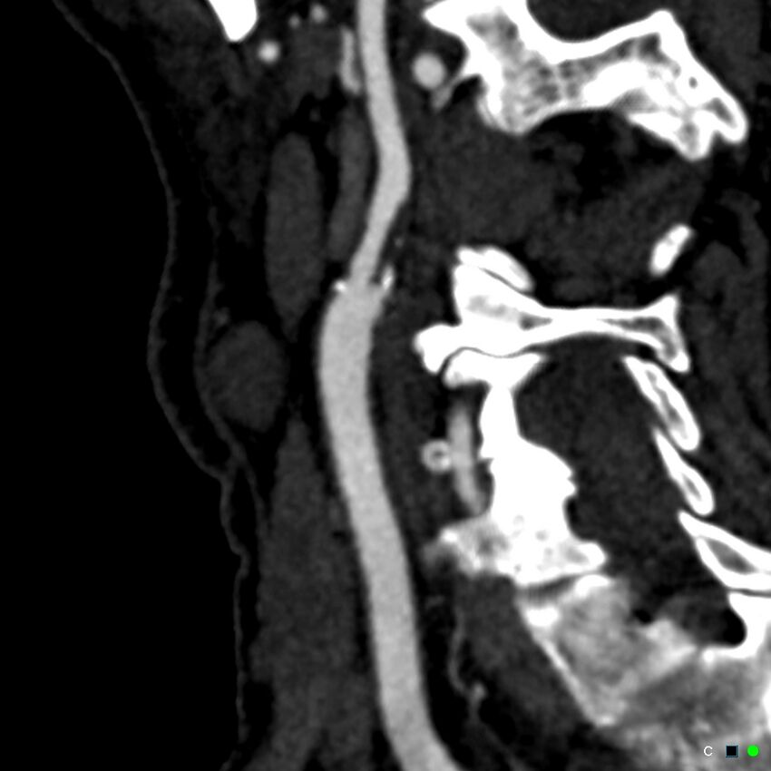 Non-occlusive intraluminal internal carotid artery thrombus (Radiopaedia 37751-39658 C 45).jpg