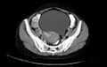 Non-puerperal uterine inversion (Radiopaedia 78343-91094 A 3).jpg