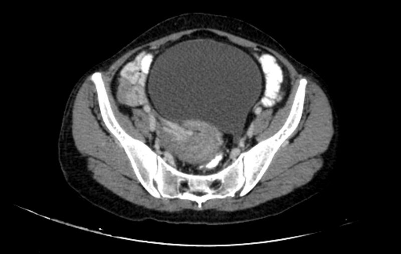 File:Non-puerperal uterine inversion (Radiopaedia 78343-91094 A 3).jpg