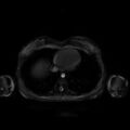 Normal MRI abdomen in pregnancy (Radiopaedia 88001-104541 D 4).jpg