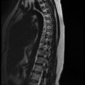 Normal cervical and thoracic spine MRI (Radiopaedia 35630-37156 G 3).png