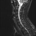 Normal cervical spine MRI (Radiopaedia 38418-40496 Sagittal STIR 5).jpg