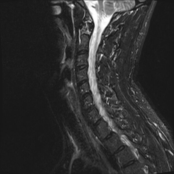 File:Normal cervical spine MRI (Radiopaedia 38418-40496 Sagittal STIR 5).jpg