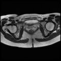 Normal female pelvis MRI (retroverted uterus) (Radiopaedia 61832-69933 Axial T2 23).jpg