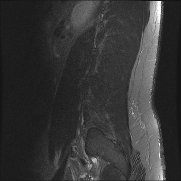 File:Normal lumbar spine MRI (Radiopaedia 43051-46311 Sagittal STIR 2).jpg