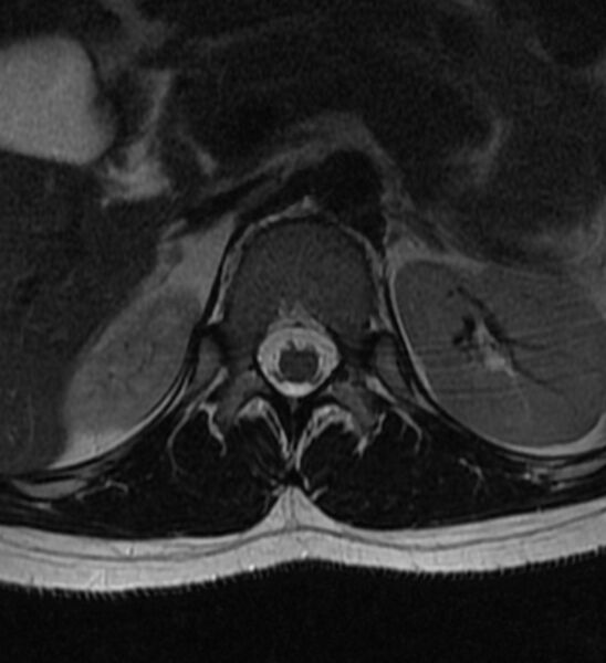 File:Normal thoracic spine MRI (Radiopaedia 41033-43781 Axial T2 29).jpg