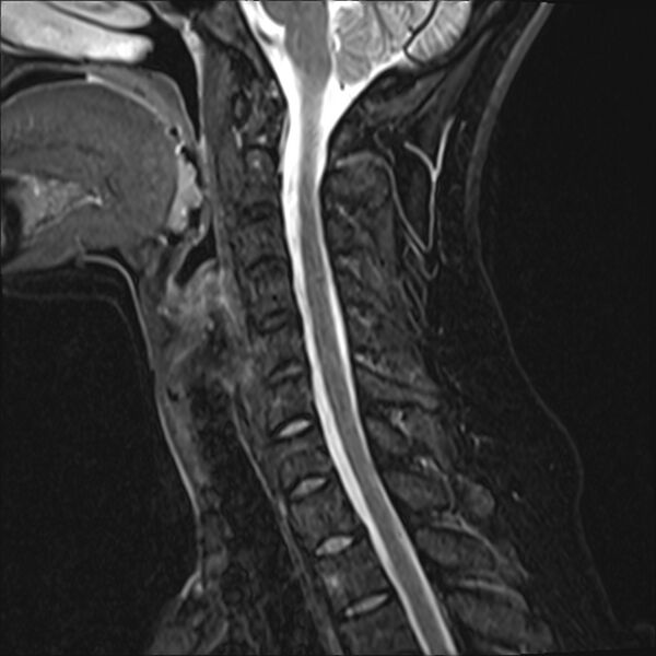 File:Normal trauma cervical spine MRI (Radiopaedia 32130-33071 Sagittal STIR 9).jpg
