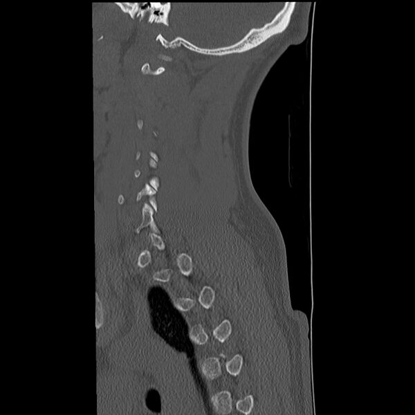 File:Normal trauma spine imaging (Radiopaedia 31753-32686 Sagittal bone window 34).jpg