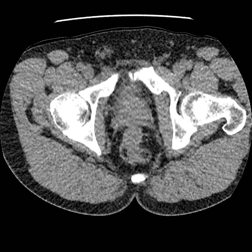 Obstructing ureteric calculus and ureteric anatomy (Radiopaedia 62730-71042 Axial non-contrast 168).jpg