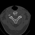 Occipital condyle fracture (Radiopaedia 31755-32691 Axial bone window 25).jpg