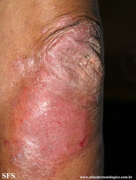 File:Psoriasis (Dermatology Atlas 129).jpg