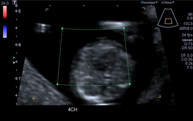 File:1st trimester nuchal-morphology ultrasound (Radiopaedia 44706-48477 Heart views cine with colour 27).jpg