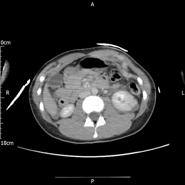 File:AAST grade IV kidney injury with CEUS follow-up (Radiopaedia 72353-82877 Axial C+ portal venous phase 31).jpg