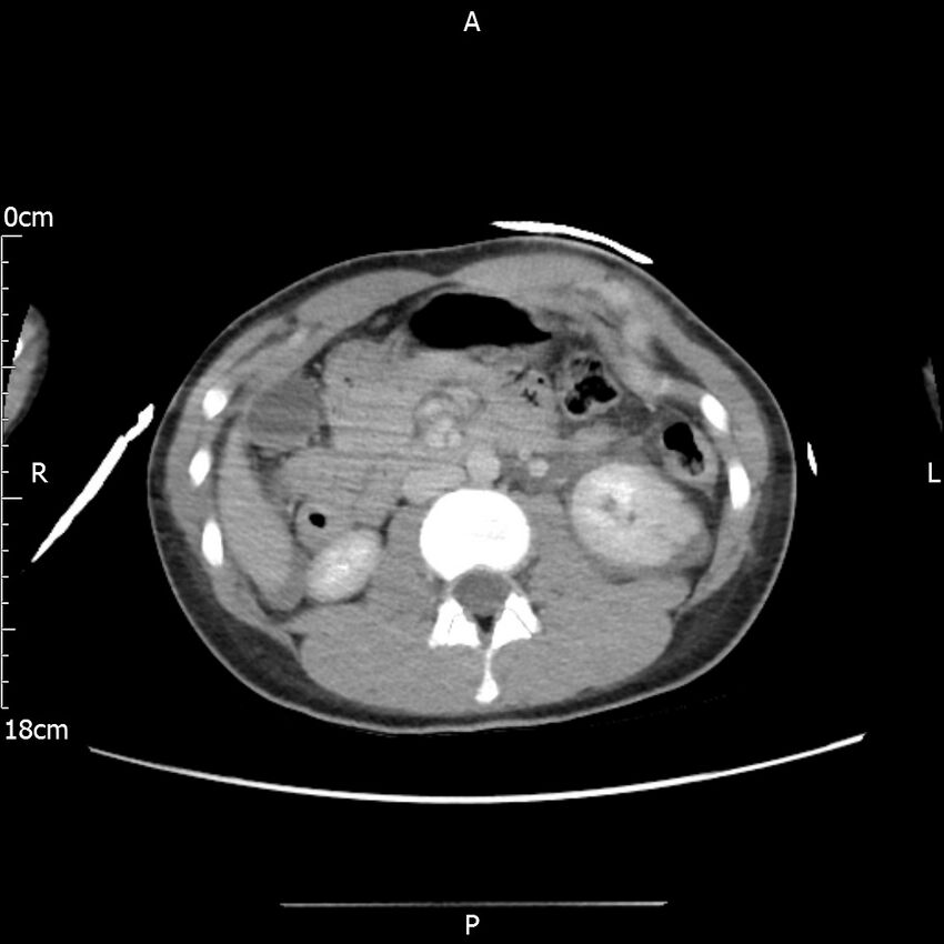 AAST grade IV kidney injury with CEUS follow-up (Radiopaedia 72353-82877 Axial C+ portal venous phase 31).jpg