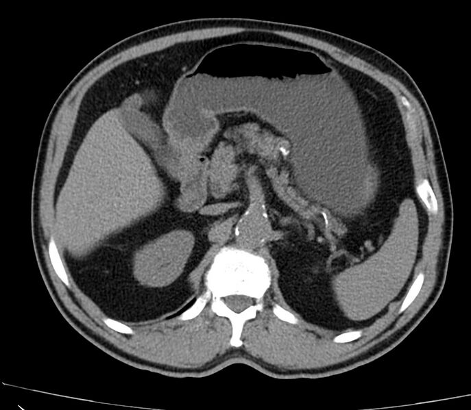 File:Abdominal aortic aneurysm (Radiopaedia 22421-22458 non-contrast 16).jpg