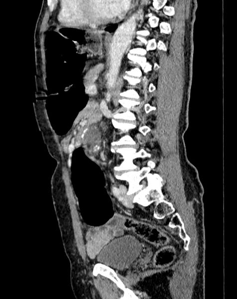 File:Abdominal aortic aneurysm (Radiopaedia 83581-98689 Sagittal C+ portal venous phase 67).jpg