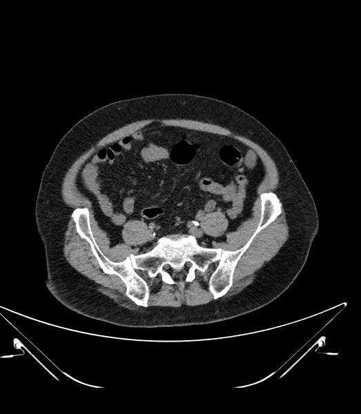 File:Abdominal aortic aneurysm with thrombus fissuration (Radiopaedia 46218-50618 Axial non-contrast 41).jpg