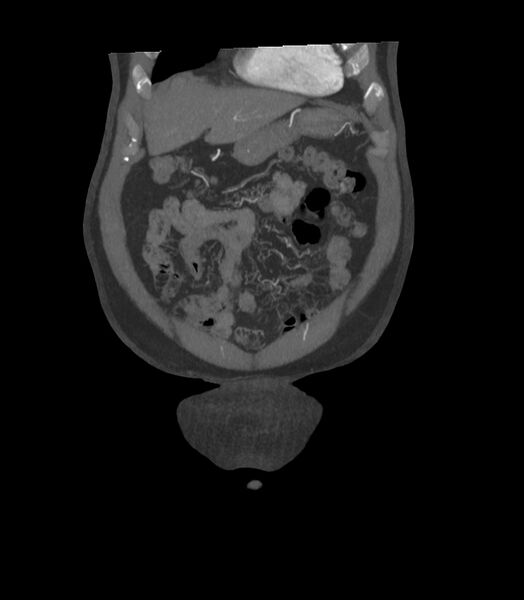 File:Abdominal aortic aneurysm with thrombus fissuration (Radiopaedia 46218-50618 Coronal C+ arterial phase 35).jpg