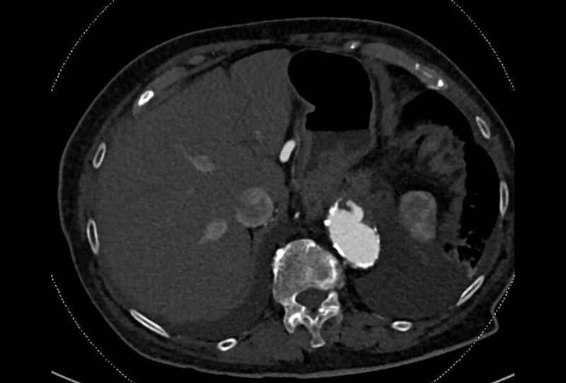 File:Abdominal aortic aneurysm with thrombus fissuration (Radiopaedia 73192-83919 Axial C+ arterial phase 14).jpg