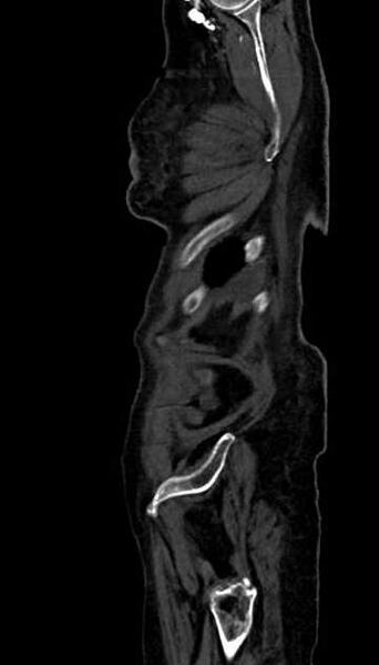 File:Abdominal aortic aneurysm with thrombus fissuration (Radiopaedia 73192-83919 Sagittal C+ arterial phase 3).jpg