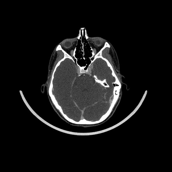 File:Aberrant right internal carotid artery (Radiopaedia 65191-74197 Axial C+ arterial phase 11).jpg