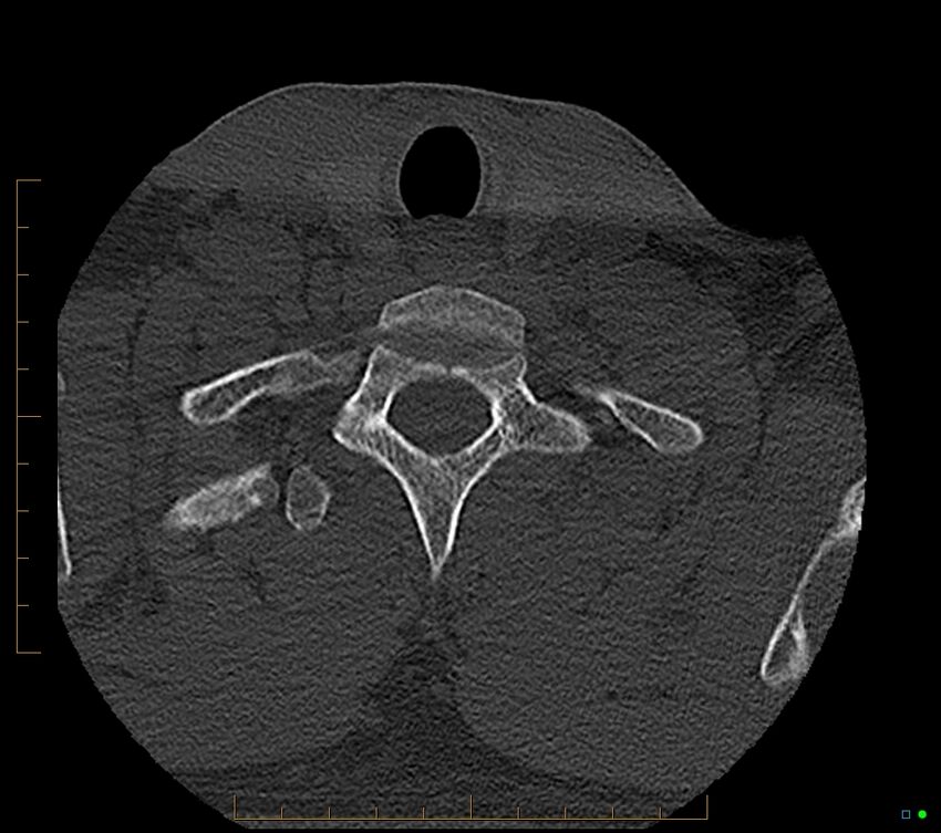 Accessory articulation of cervical transverse processes (Radiopaedia 82715-96933 Axial non-contrast 128).jpg