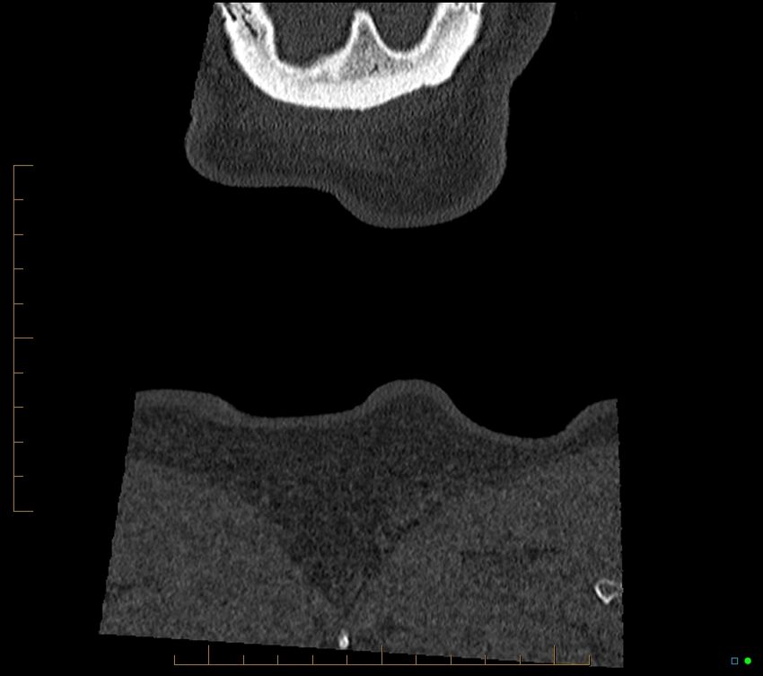 Accessory articulation of cervical transverse processes (Radiopaedia 82715-96933 Coronal non-contrast 138).jpg