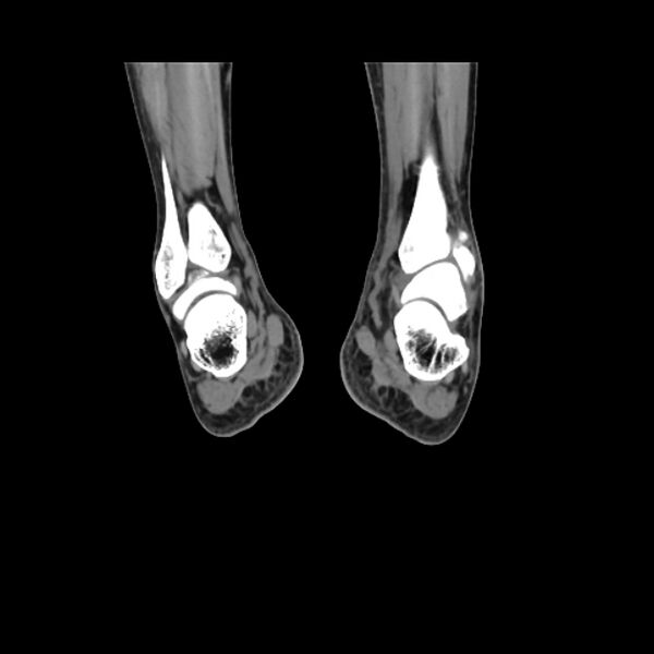 File:Accessory soleus muscle (Radiopaedia 61069-68943 Coronal non-contrast 51).jpg