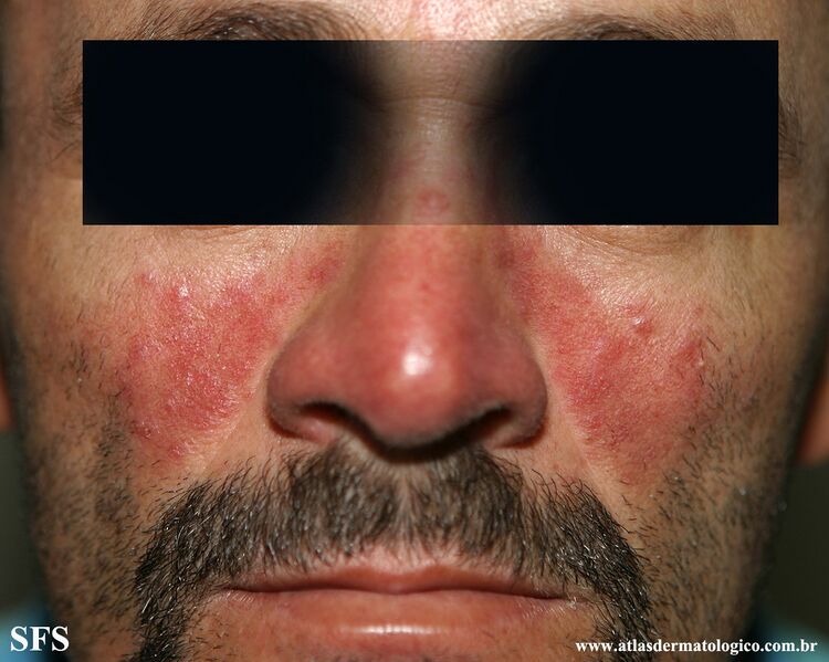 File:Acne Rosacea (Dermatology Atlas 24).jpg