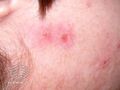Acne excorie (DermNet NZ acne-acne-excorie2).jpg